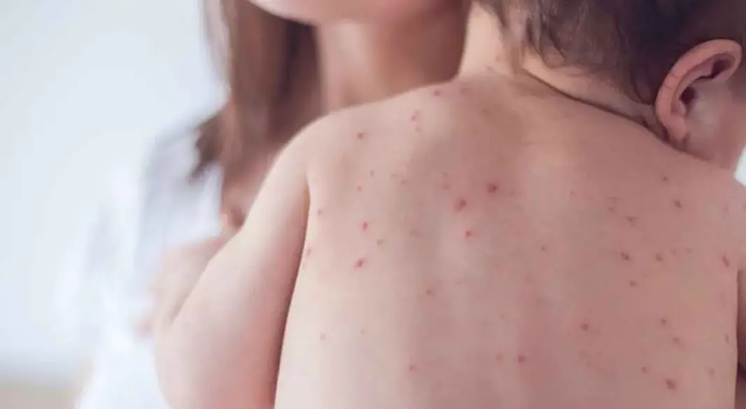 হাম আক্রান্ত শিশু। ছবি : সংগৃহীত